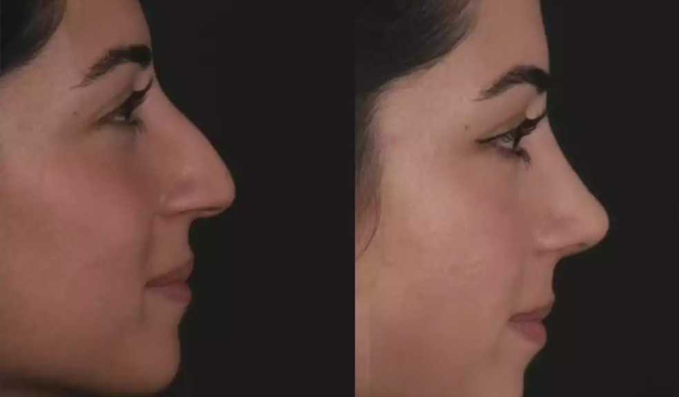 H-Rhinoplasty-7 (2)