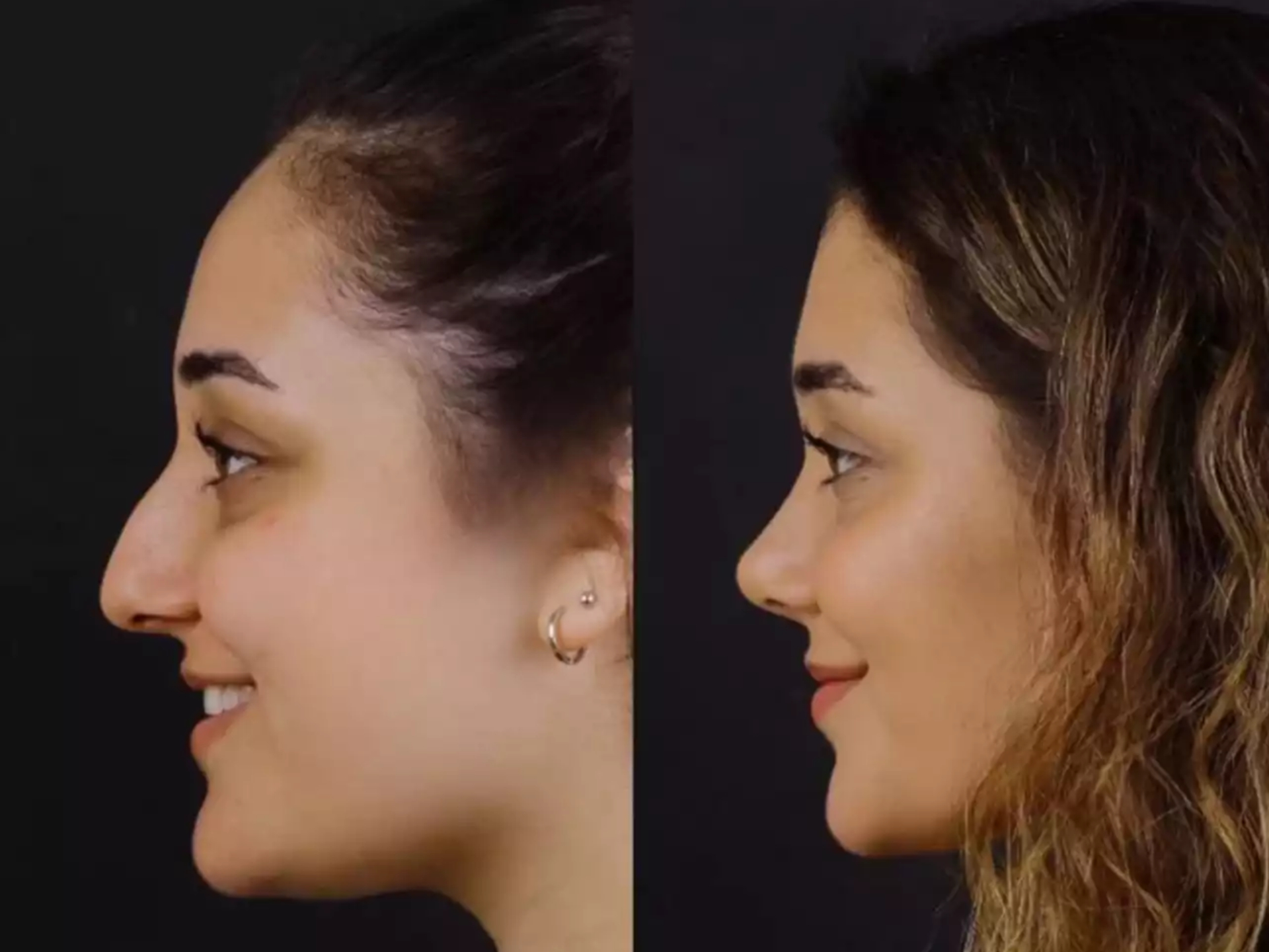 H-Rhinoplasty-8