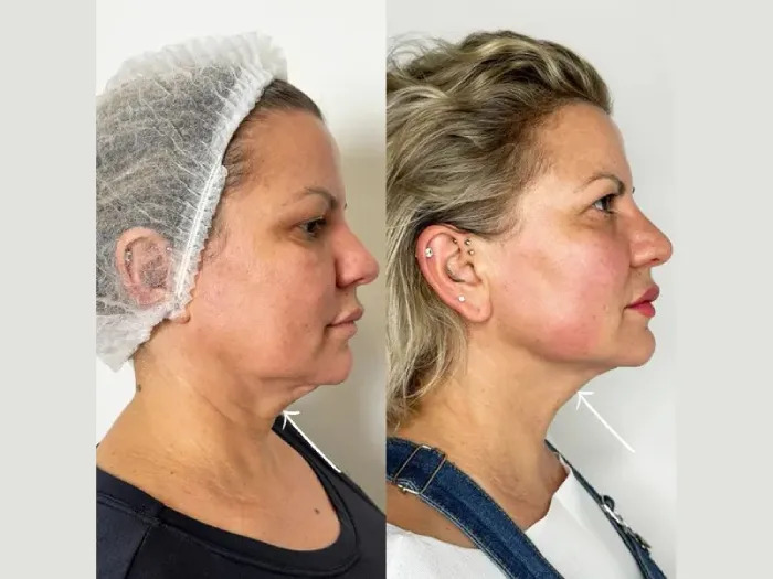 H5-Endolift