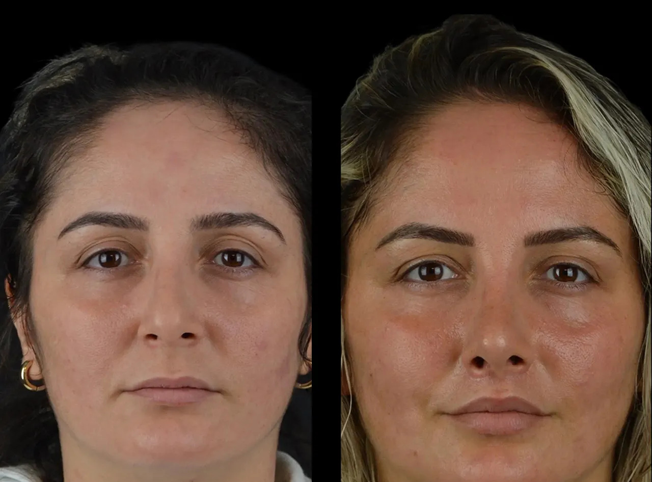 H6-Cheek-Fillers (1)