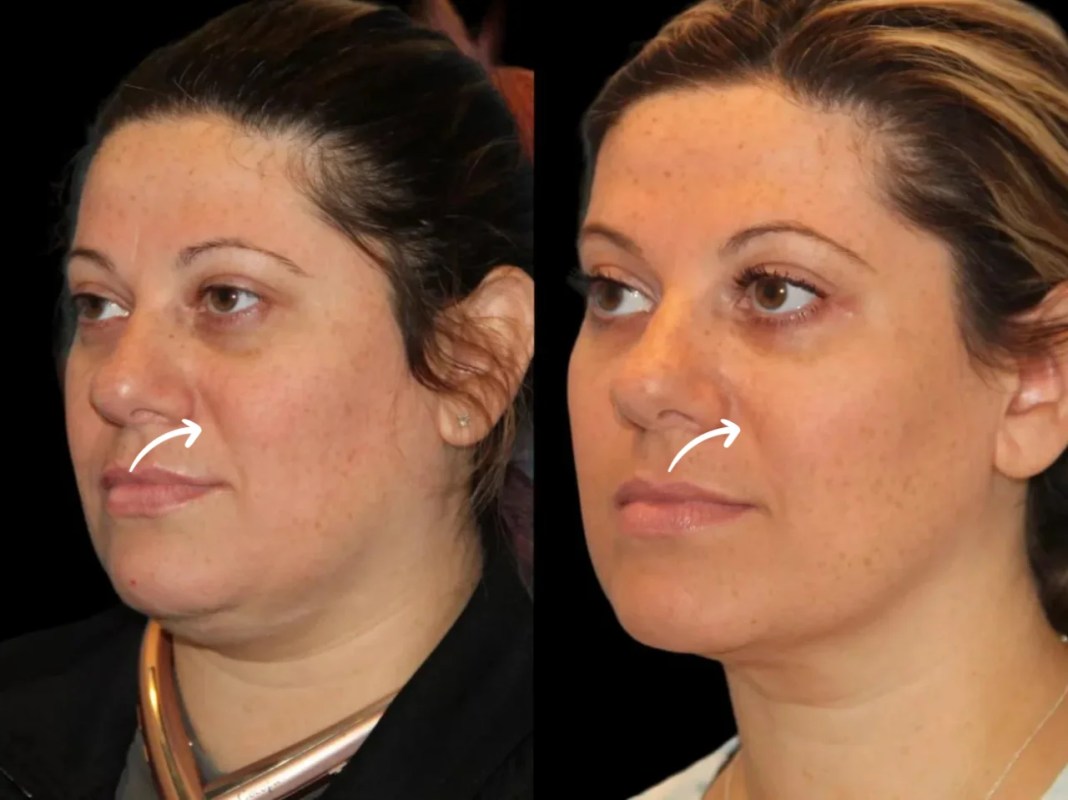 H7-Sculptra