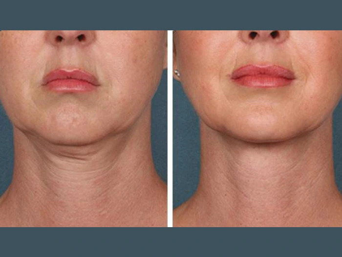 PRP Treatment in Dubai