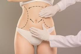 Tummy tuck .2