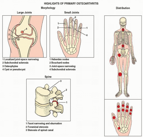degenerative joint disease icd 10 1