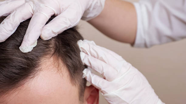 medical-worker-in-gloves-examines-the-head-of-a-balding-man-close-up