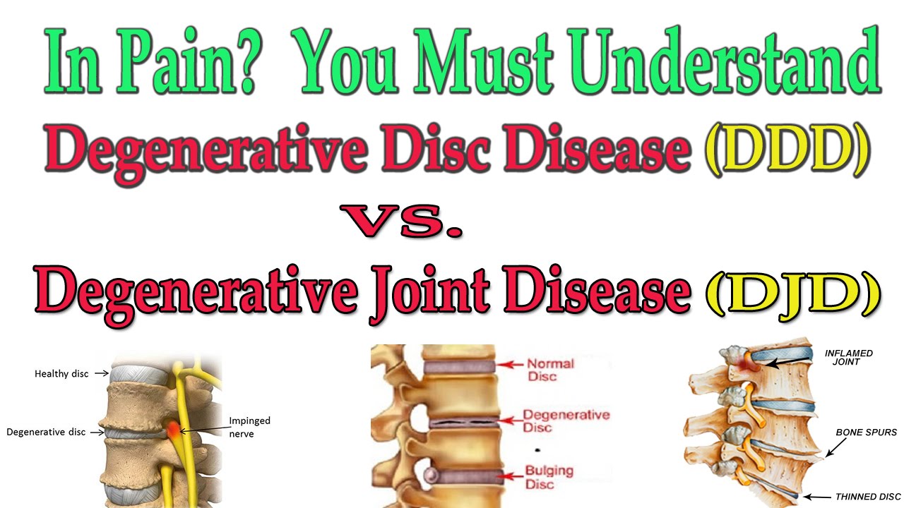things to avoid with degenerative disc disease 1