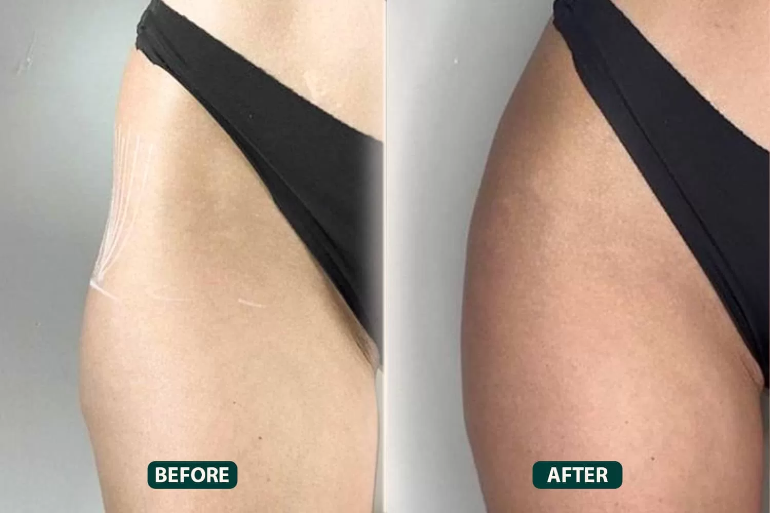 Body-Fillers-1