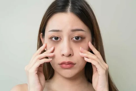 Dark Circles Treatment in Islamabad2