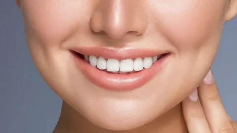Dental Veneers in Islamabad  1
