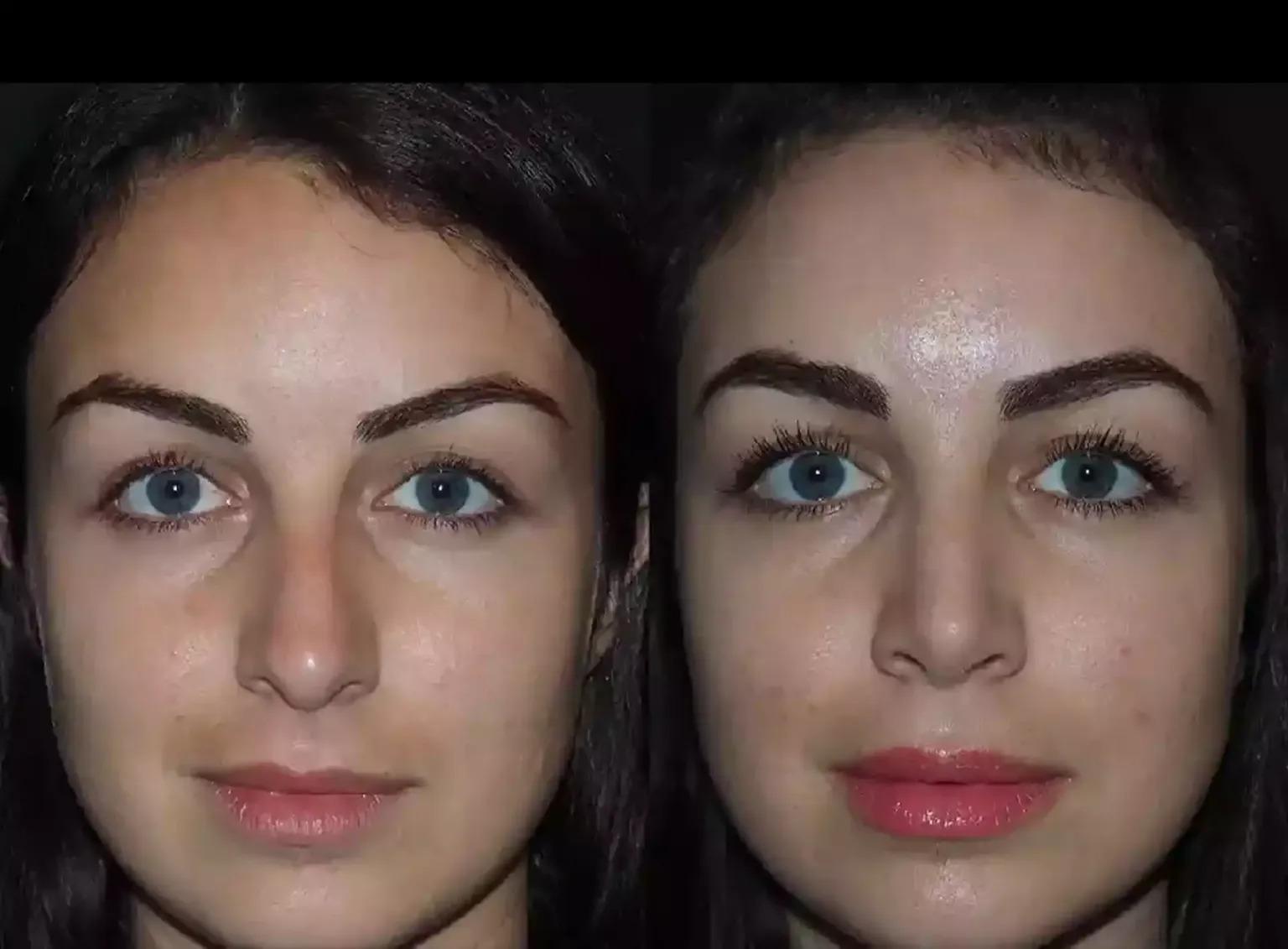 H-Rhinoplasty-15_11zon