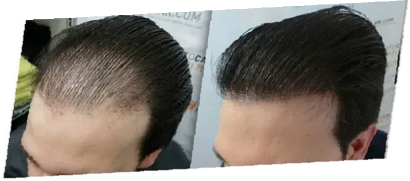 hair transplant in Dubai