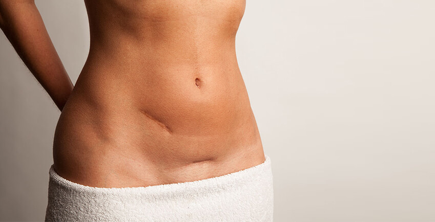Abdominoplasty-Scar-IAAPS-01