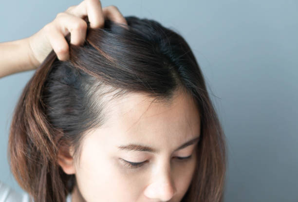 Are Hair Loss Treatments in Dubai Effective for Scarring Alopecia