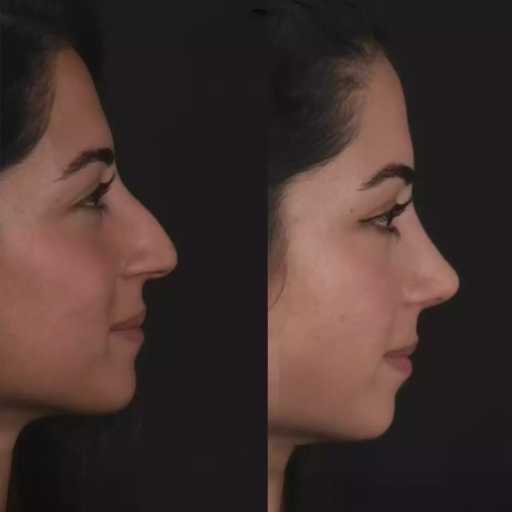 H-Rhinoplasty-7 (1)