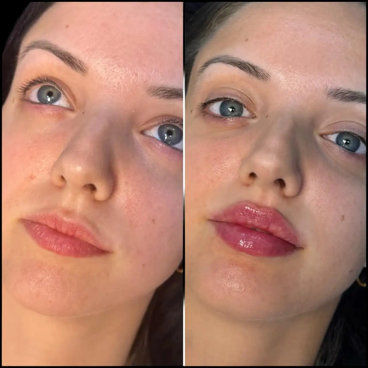 H5-lip-fillers (Fillers in Dubai) (1)