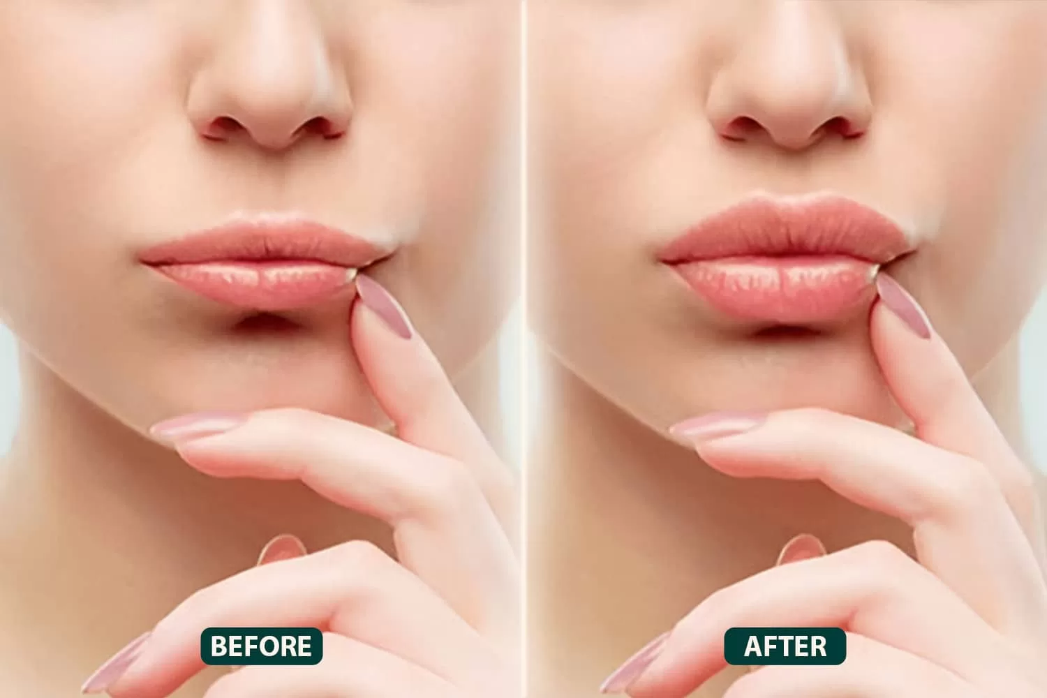 How Lip Fillers Injections Can Help Achieve Balanced Beauty