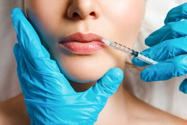 Lip Fillers in Dubai