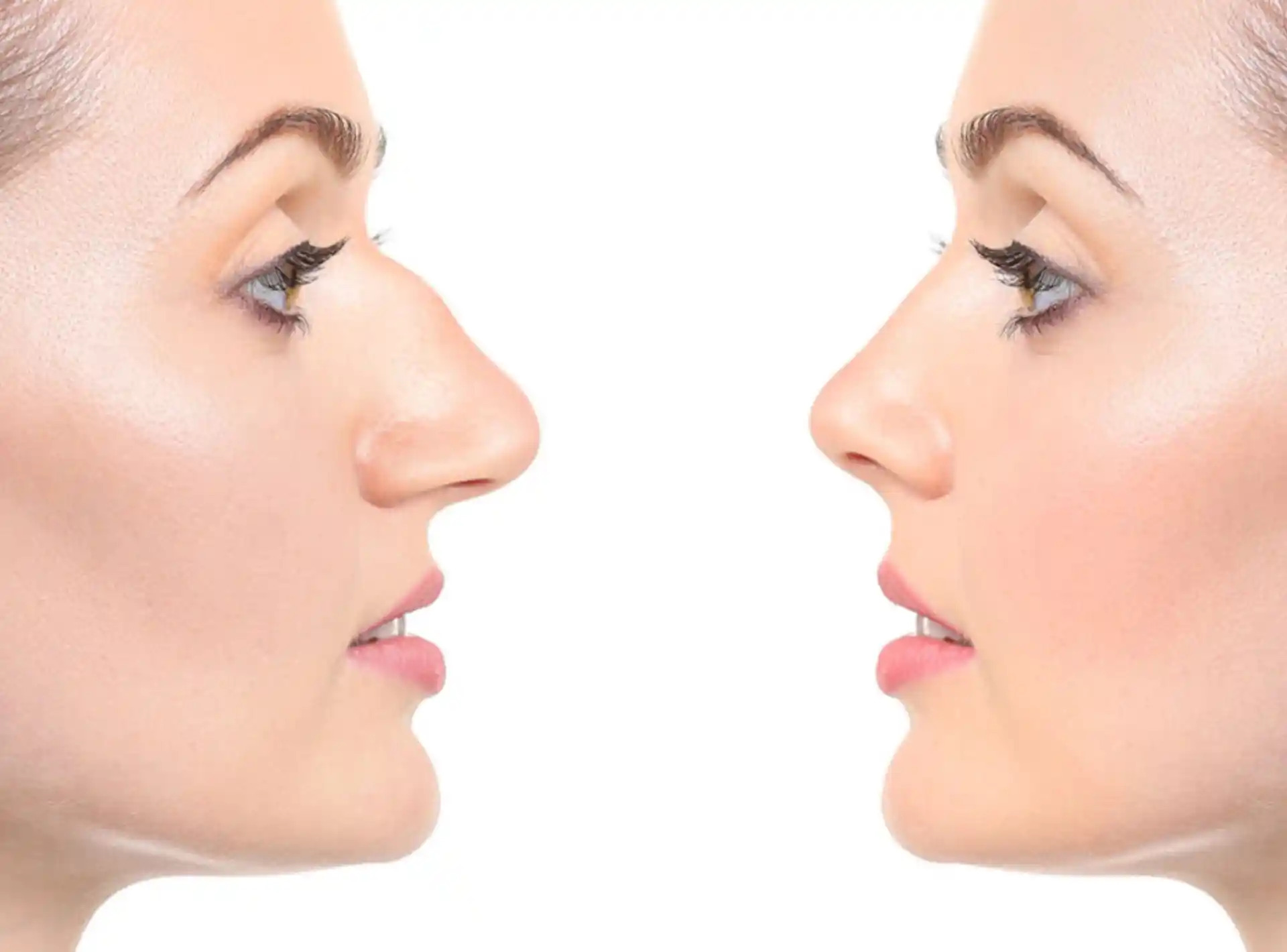 Rhinoplasty