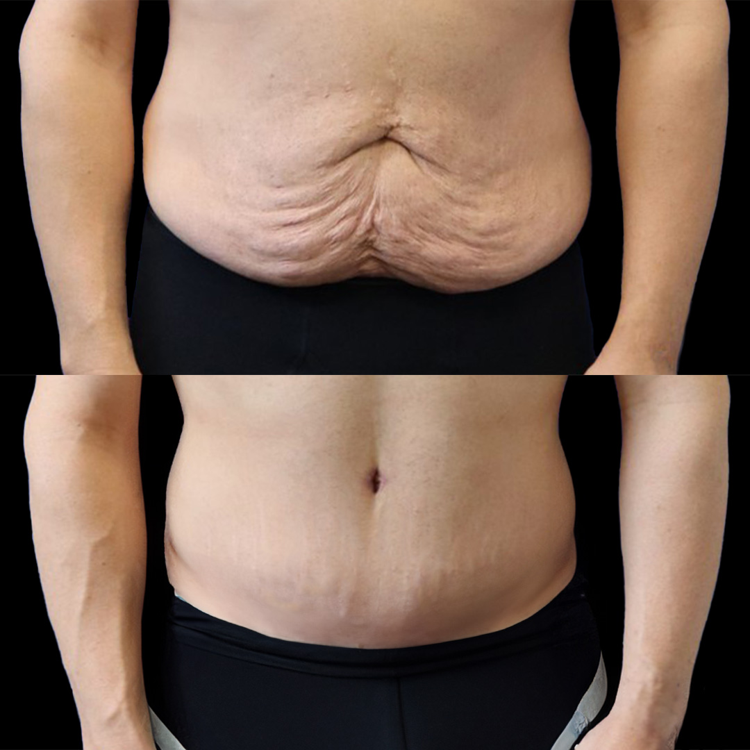 What Is a Reverse Tummy Tuck and Who Needs It