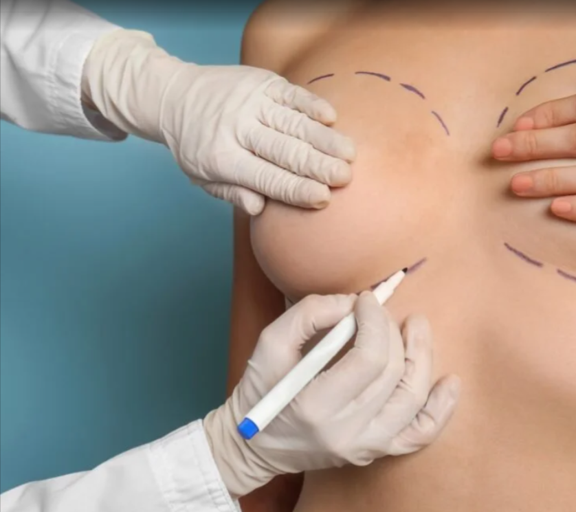 breast implant