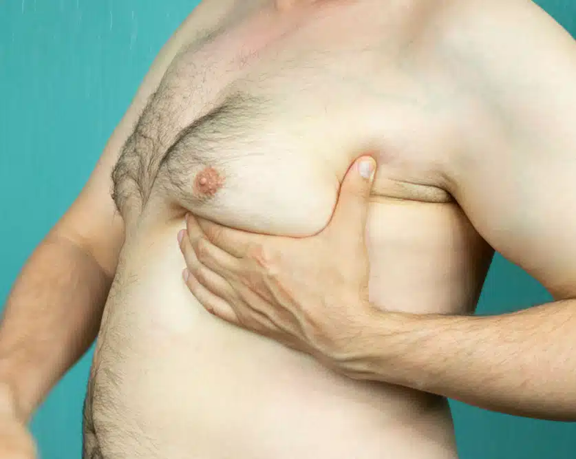 gynecomastia-grades-dr-steinbrech-ny-1