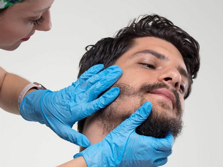 Beard hair transplant in Islamabad