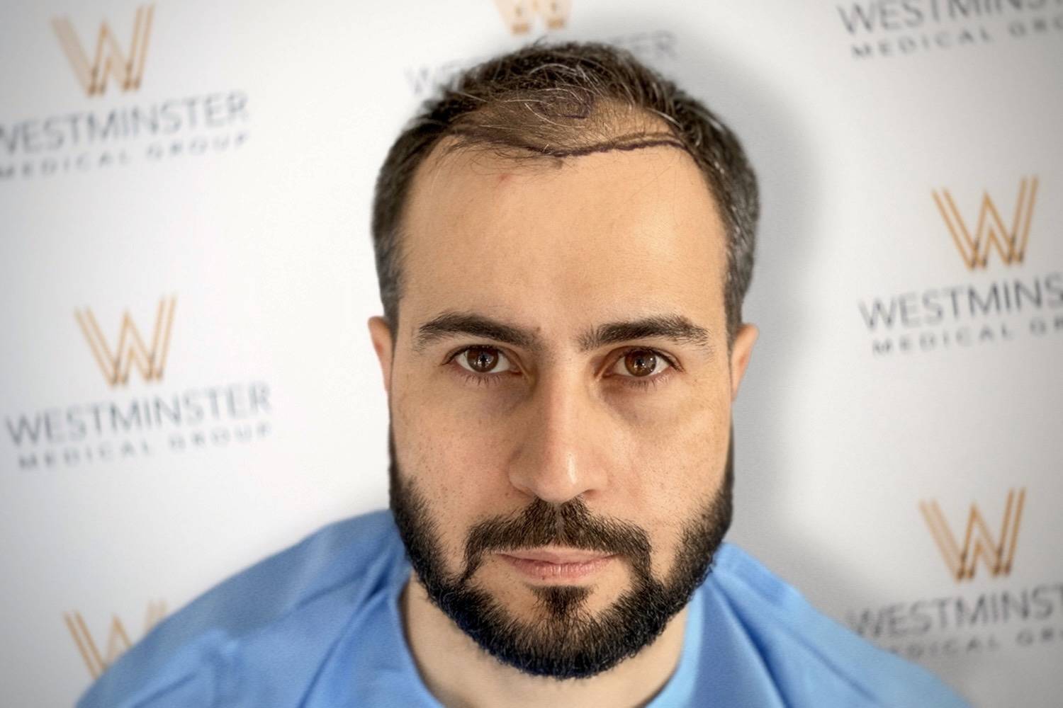 FUE-Hair-Transplant-UK-Westminster-Medical-Group-London-Before1-2-1