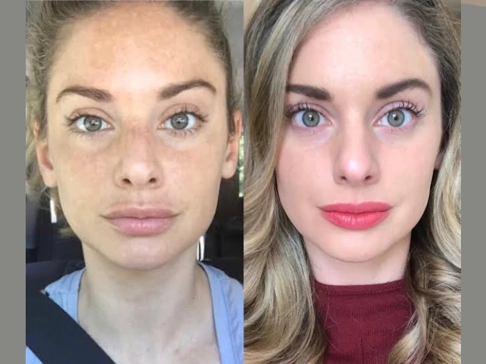 Radiofrequency (RF) Microneedling Clinics in dubai