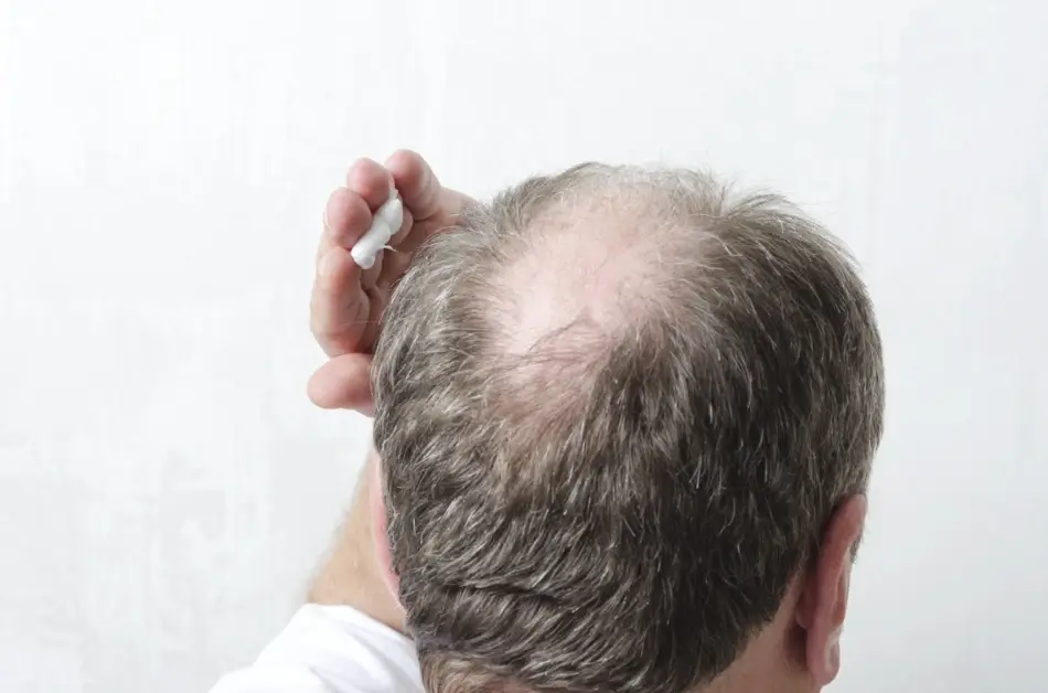 Topical-vs-oral-finasteride-1