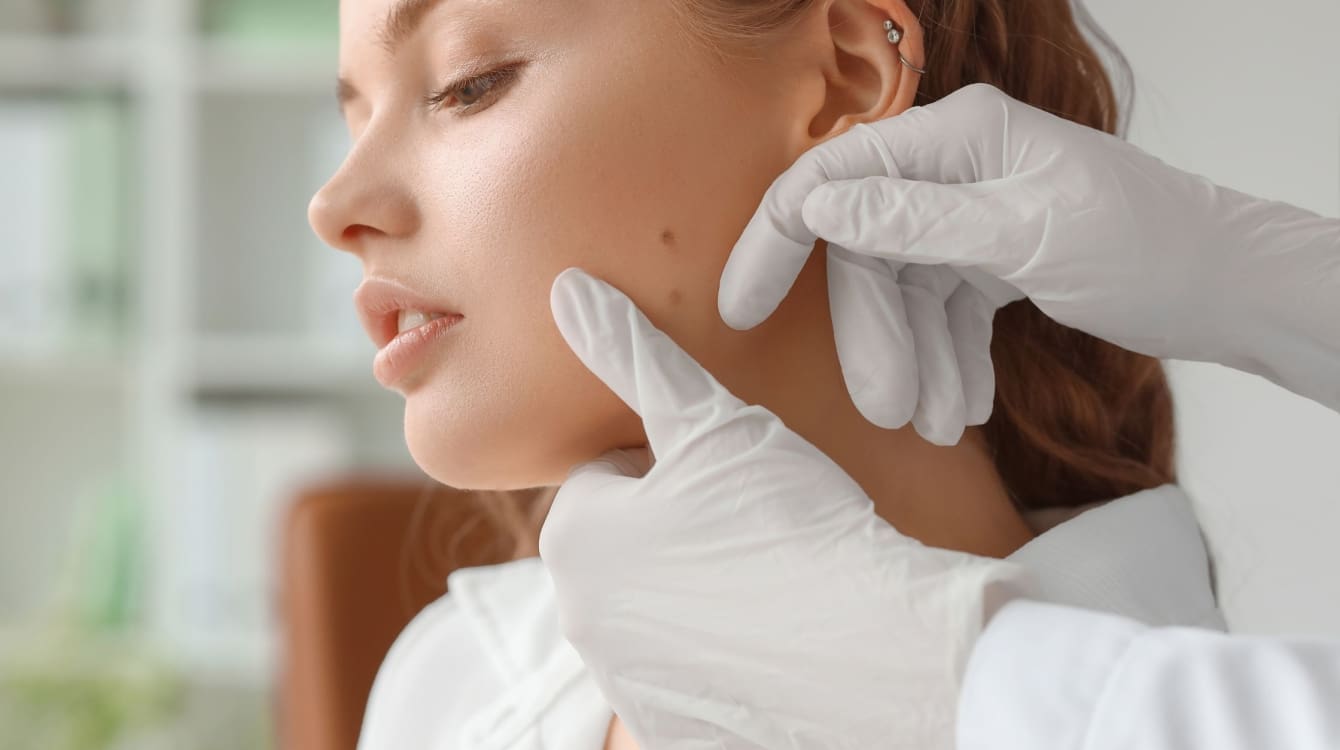 Moles Removal in Dubai