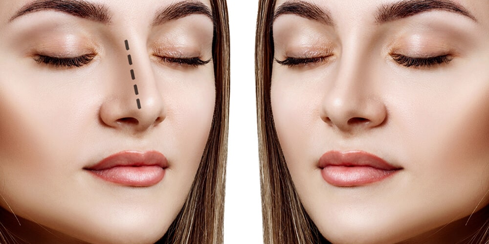 Why Is Rhinoplasty Price So Different Everywhere