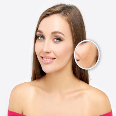 chemical peels in riyahd