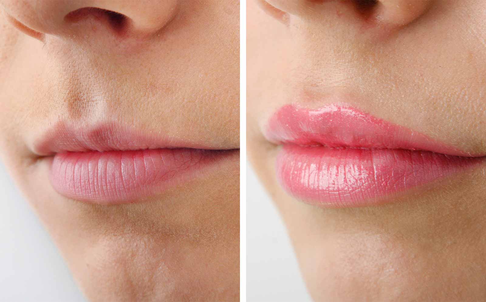 lip-augmentation-lip-filler-shapes